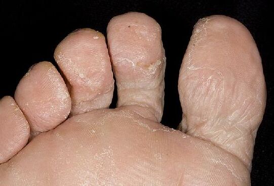 Objawy infekcji grzybiczej na stopach