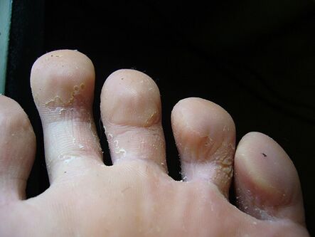Złuszczanie się i łuszczenie się skóry na nogach jest oznaką grzybicy