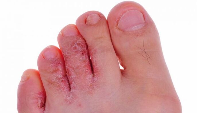 infekcja grzybicza skóry palców u nóg