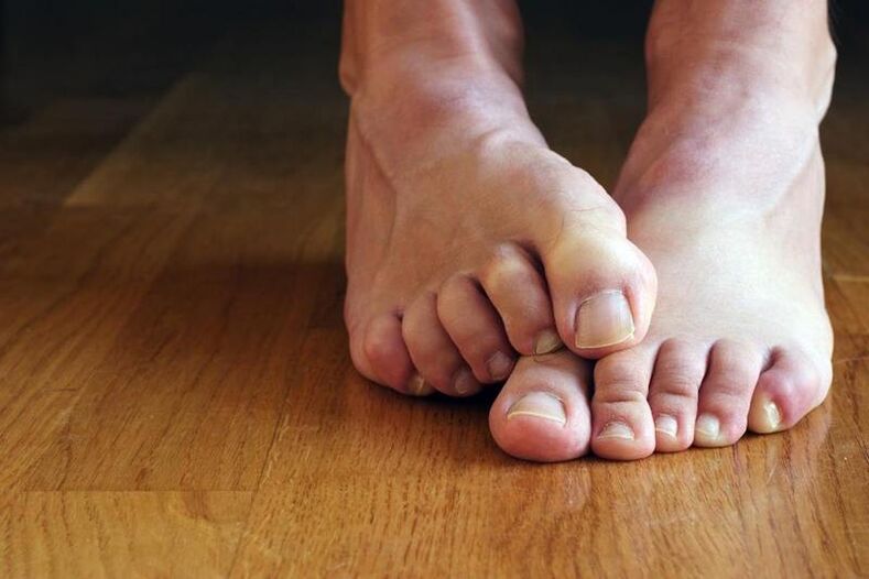 swędzące stopy z grzybicą paznokci