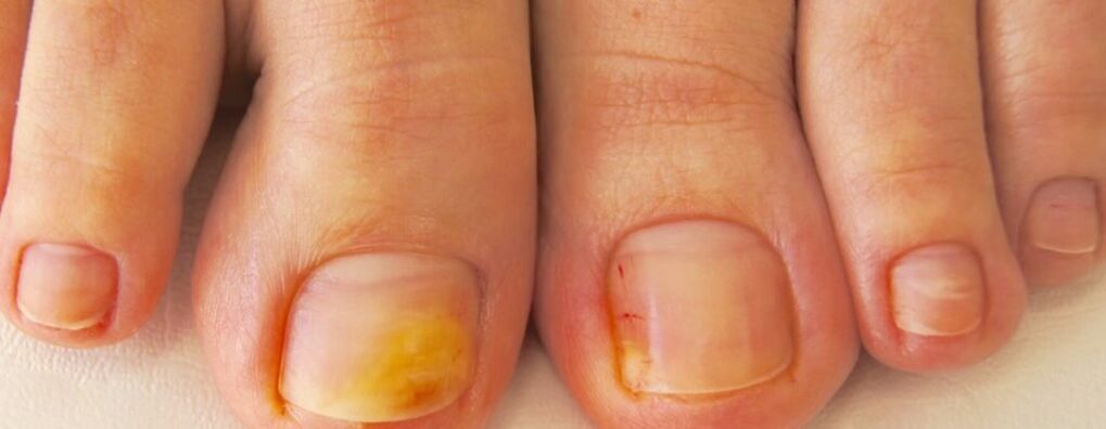 Początkowy etap grzybicy paznokci - zażółcenie paznokci