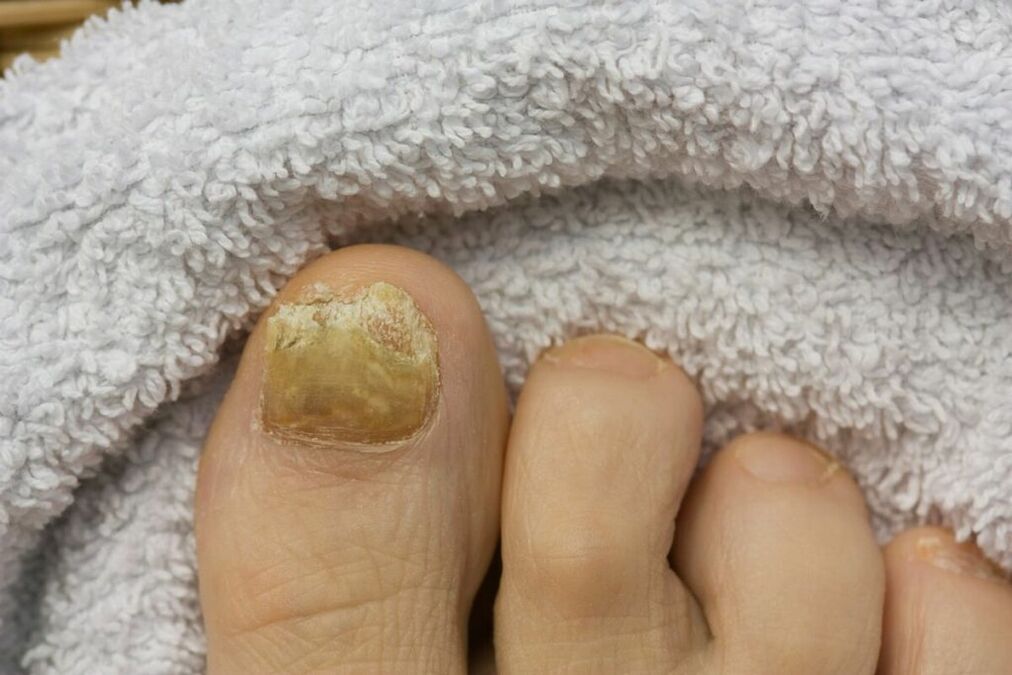 Zanikowe stadium grzyba (odpadające kawałki paznokcia)