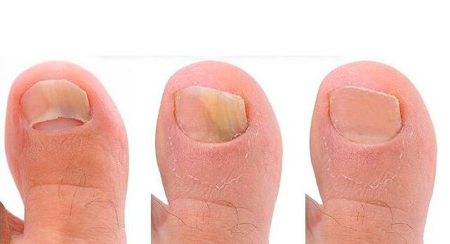 Etapy rozwoju grzybicy paznokci