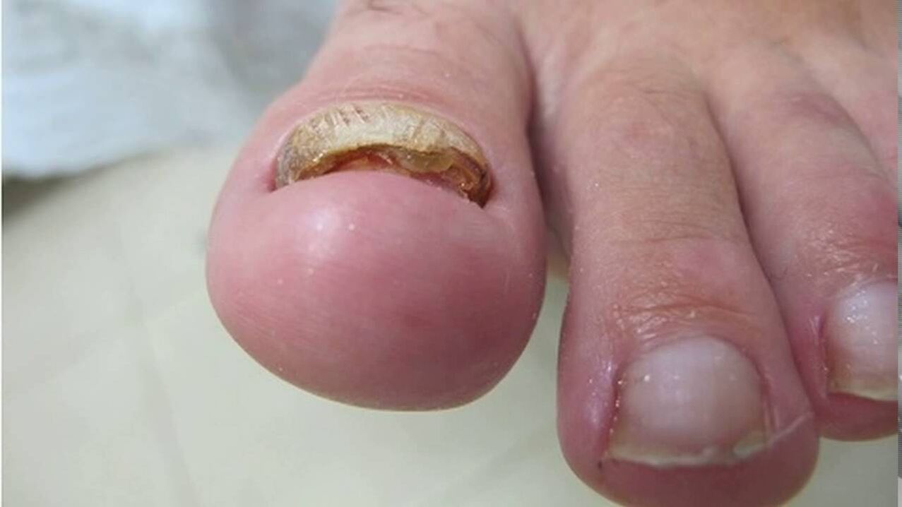 Grzyb przerostowy - deformacja krawędzi, utrata koloru i pogrubienie płytki paznokcia